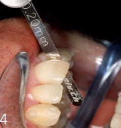 Linijka (miarka) do mierzenia strippingu IPR; 8 szt.