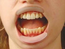 Rozwieracz do ust Spandex - Vertical; 2+2