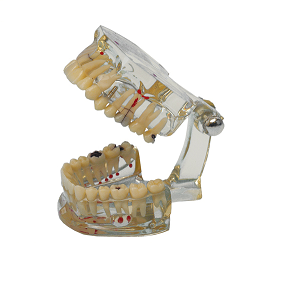 Model z próchnicą de luxe