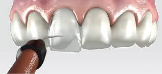 Formówki IVENEER System do licówek kompozytowych, zestaw 64 sztuk (S/M i M/L)