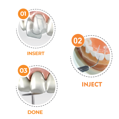 Formówki IVENEER System do licówek kompozytowych, zestaw 64 sztuk (S/M i M/L)