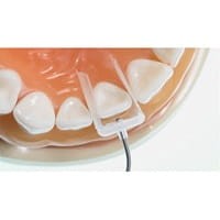 Formówki IVENEER System do licówek kompozytowych, zestaw 64 sztuk (S/M i M/L)