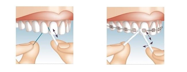 Nici Mirafloss Implant Medium, średnica 2.2 mm, op. niebieskie