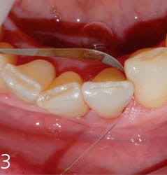 Paski z nasypem diamentowym ProxoPolish 15/08 mq; 6 szt.