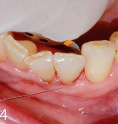 Paski z nasypem diamentowym ProxoPolish 15/08 mq; 6 szt.