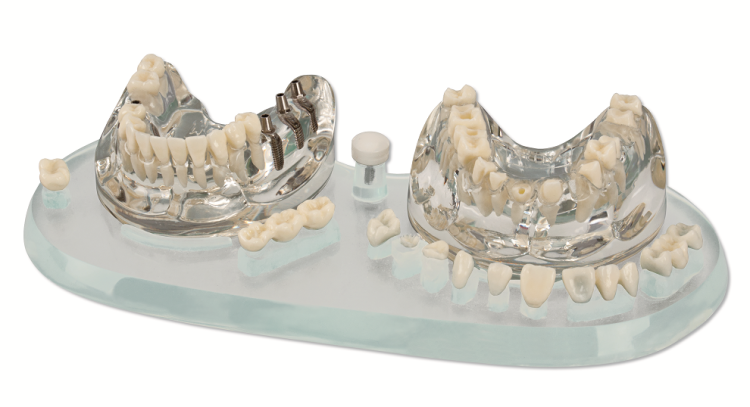 Model 11 prac protetycznych, w tym także na implantach