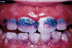 Lusterko + 3 tabletki do wykrycia osadu, Plaque Check