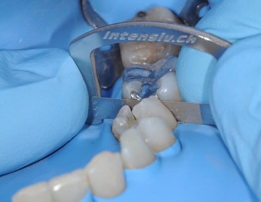 Pasek z uchwytem szczelino rozwieracz -ApproxOpener INTENSIV – nasyp dwustronny 3 szt.