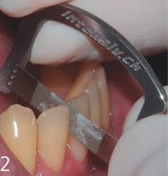 Pasek z uchwytem szczelino rozwieracz -ApproxOpener INTENSIV - nasyp jednostronny 3 szt.