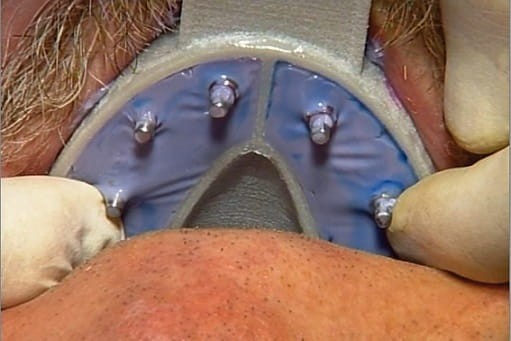 Łyżki do implantów 6 szt.- Miratray Implant żuchwa nr 2(I-2)