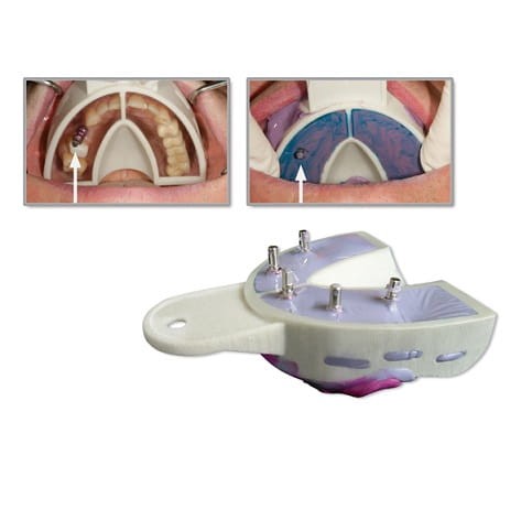 Łyżki do implantów 6 szt.- Miratray Implant żuchwa nr 2(I-2)