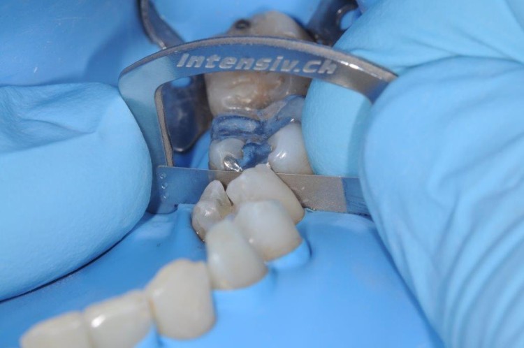 Paski z uchwytem, szczelino rozwieracz -ApproxOpener 3 szt. mix