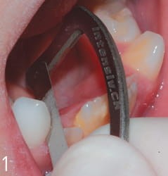 Paski z uchwytem, szczelino rozwieracz -ApproxOpener 3 szt. mix