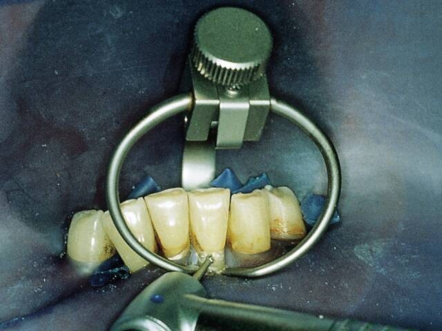 Klamra przyszyjkowa 214